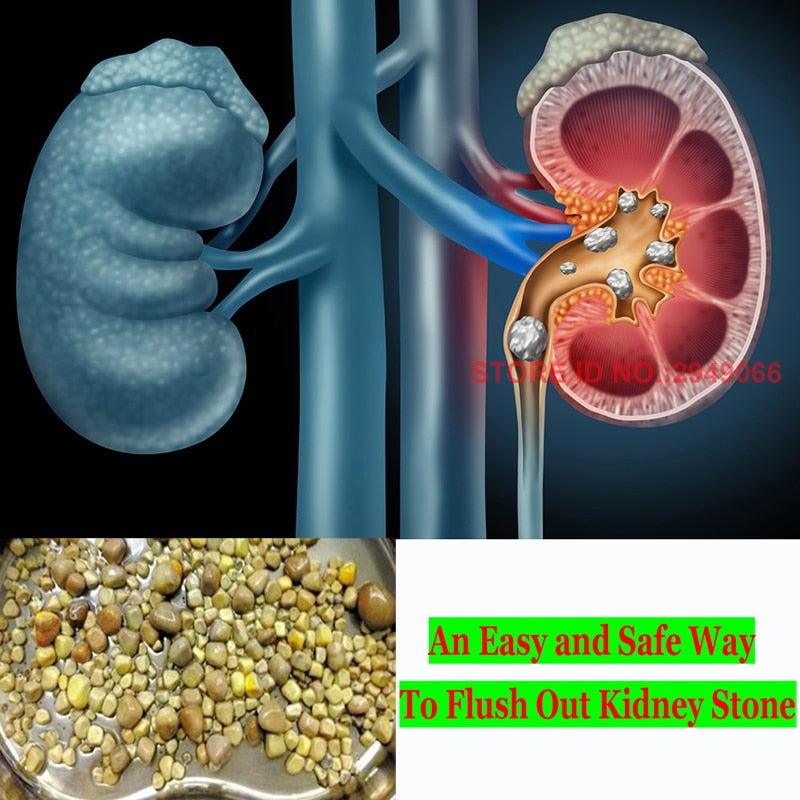 Chinese Herbs Remedy Flush Out Kidney Stoned Pain Relief for Persisent Back Urination Pain Urination